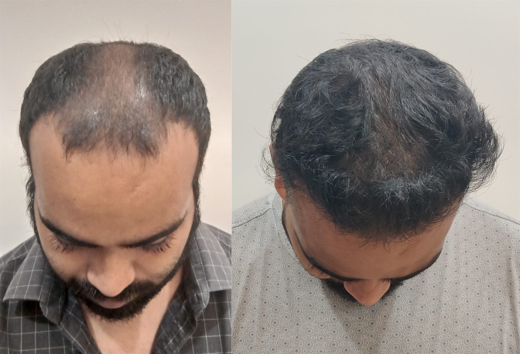 Hair transplant treatment image from Dr Vaibhav Shah website