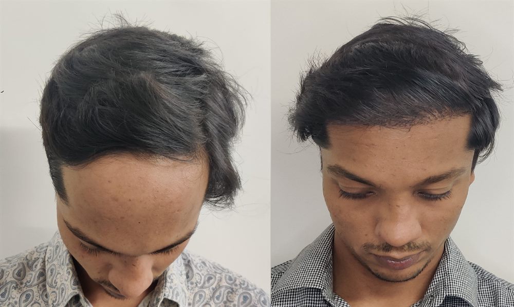 Hair transplant patient result from Dr Vaibhav Shah Clinic