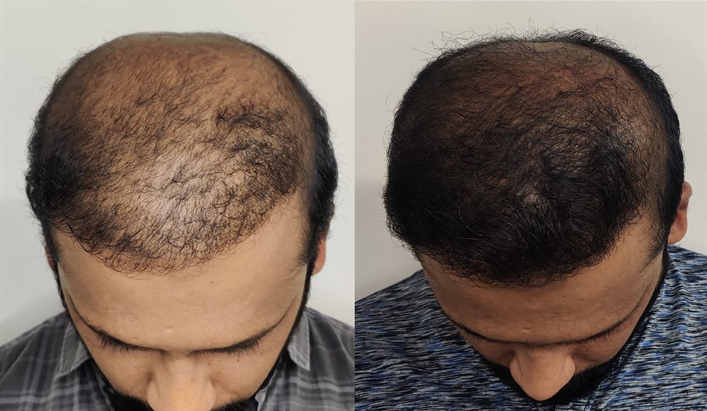 FUE hairline restoration result from Dr Vaibhav Shah Clinic